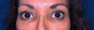 Manhattan BLEPHAROPLASTY after 6